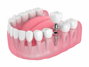 What Is an Implant Restoration?