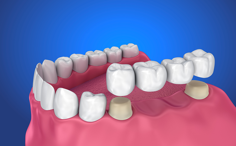 What Is a Dental Bridge?